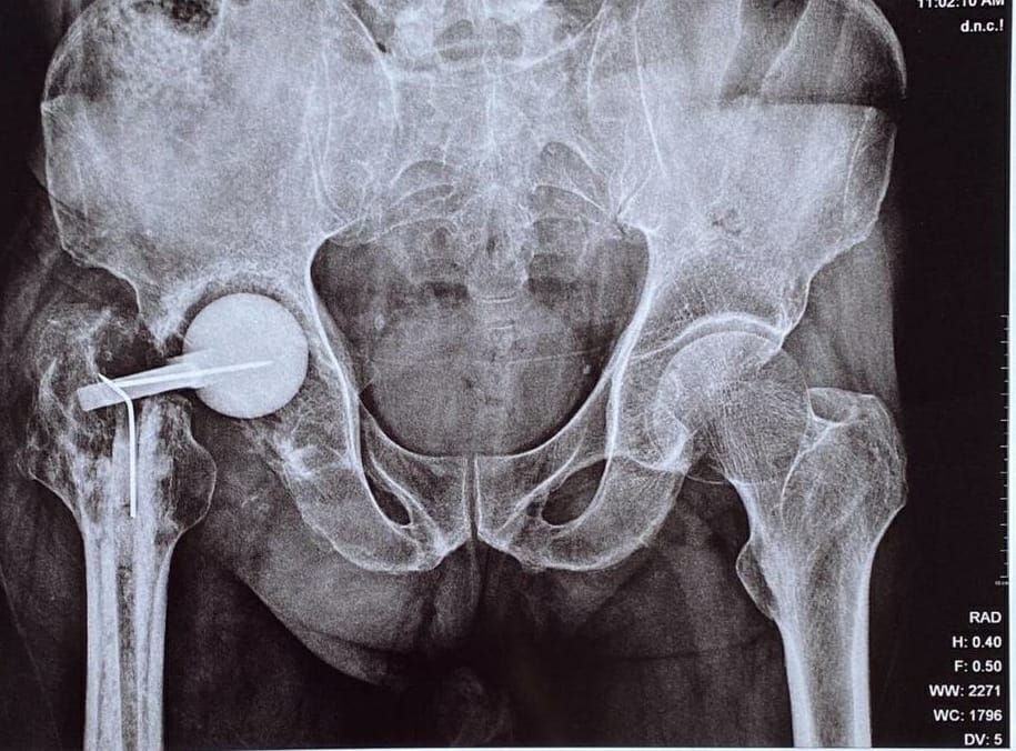 Total hip replacement
It is treatment of choice... main image