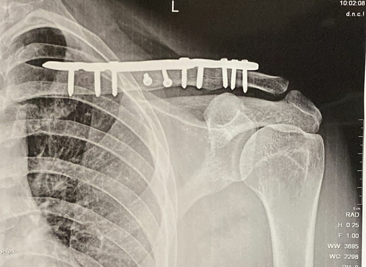 Total hip replacement
It is treatment of choice... main image