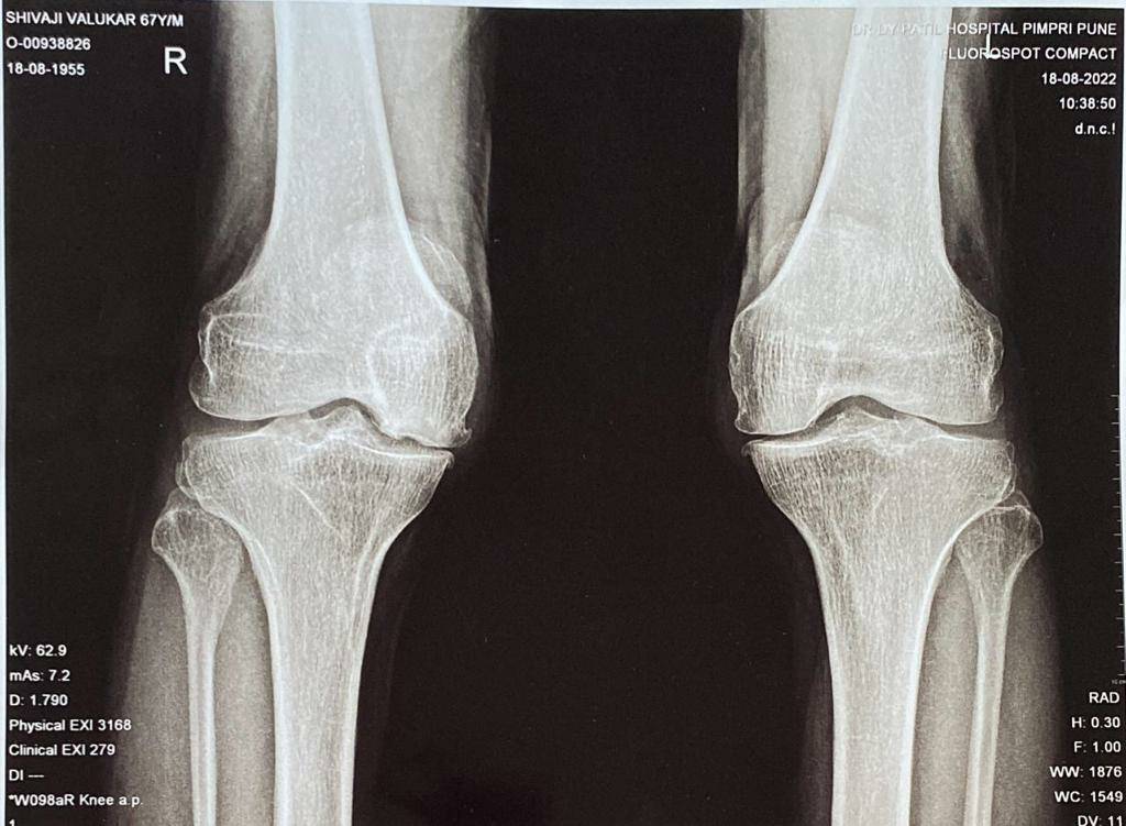 Knee pain is disabling
Donot suffer
Meet best... main image