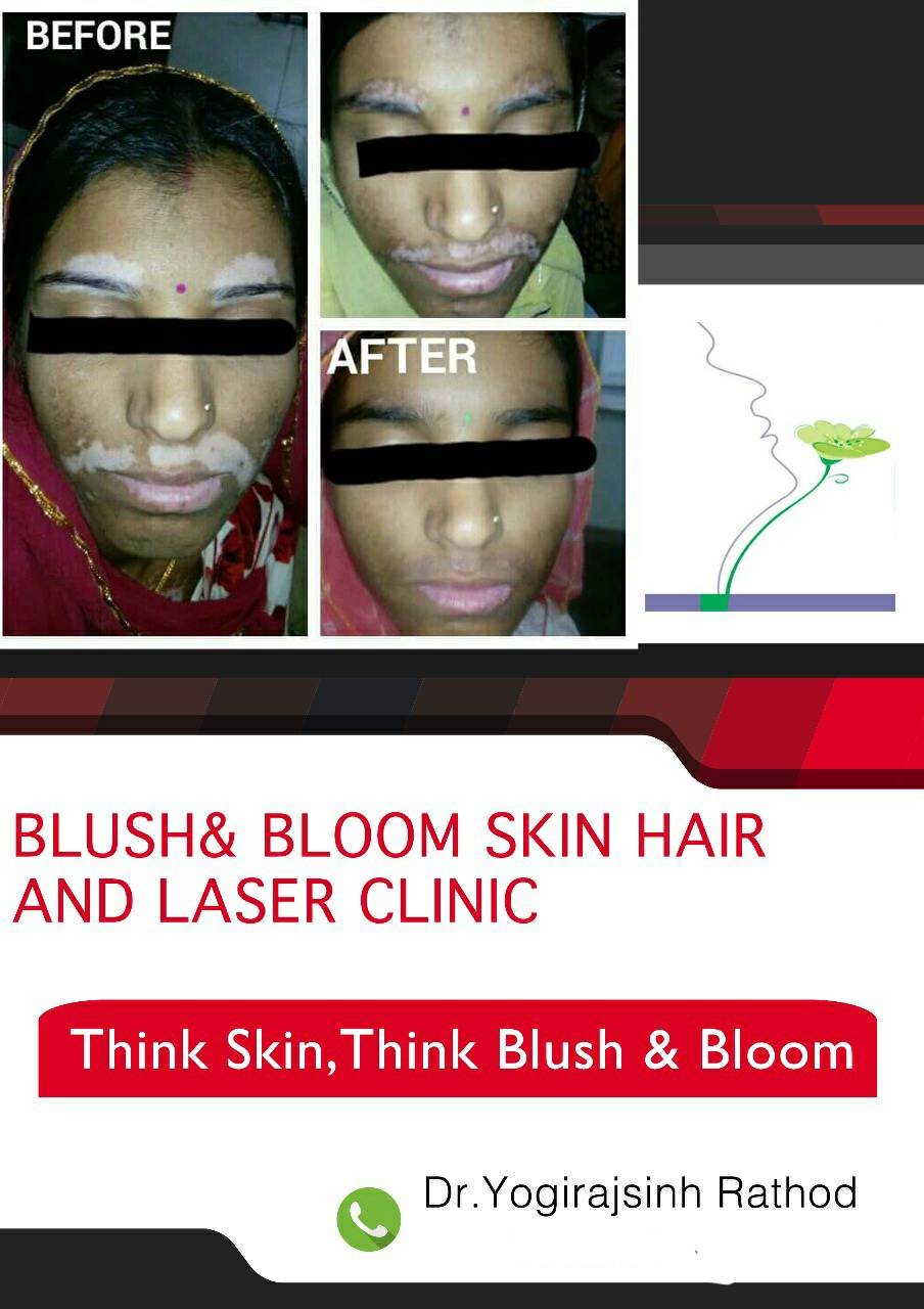 Vitiligo is curable....
Think_Skin_Think_Blush_& _... main image