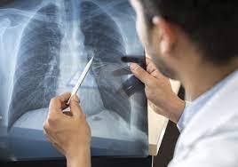 Chest clinic in Nagp