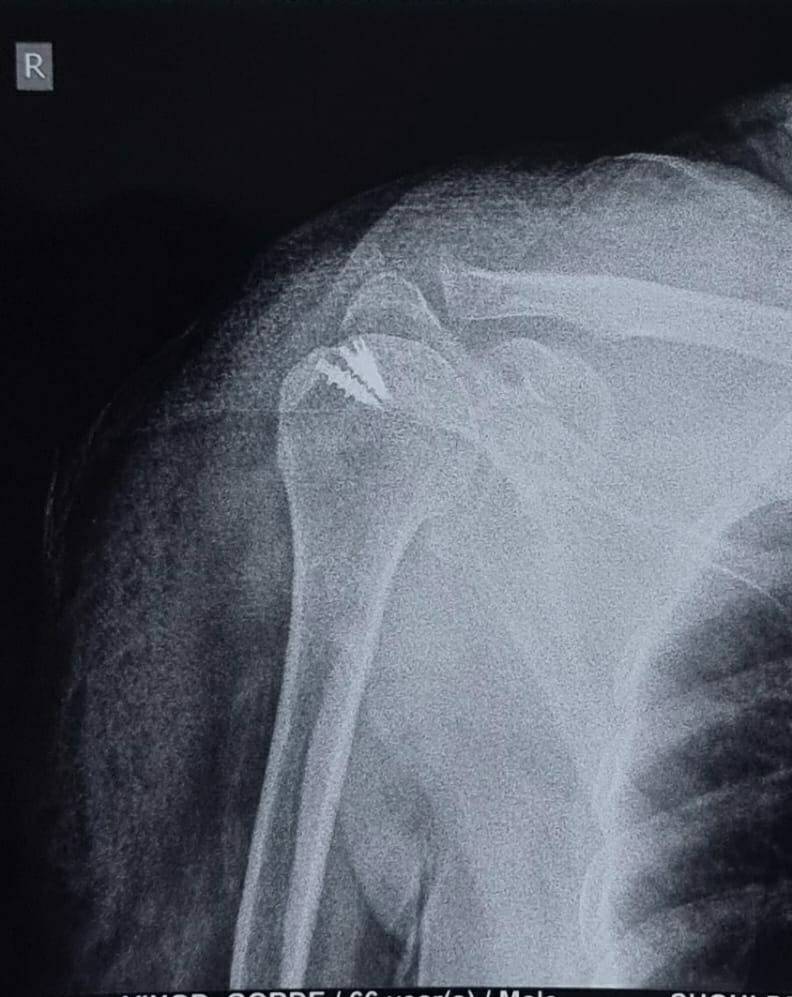 Rotator Cuff Tear
Painful condition due to tear... main image