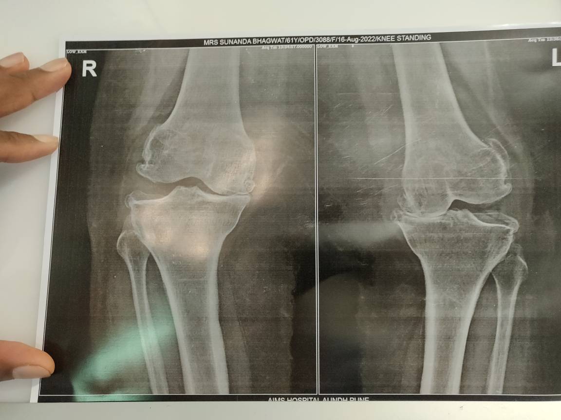 Knee pain is disabling.
It can be treated with... main image