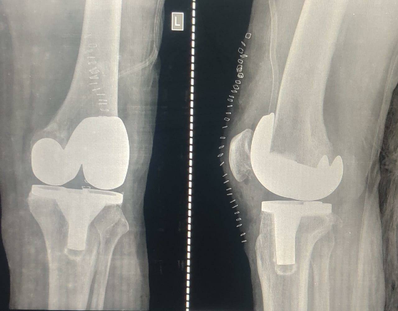 Robotic knee replacement
1. Less tissue damage... main image