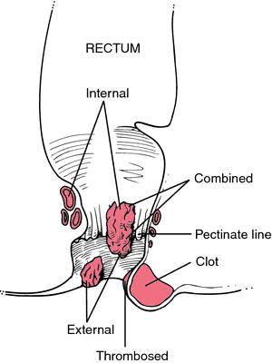 Surgery on thrombosed external hemorrhoids is b... main image