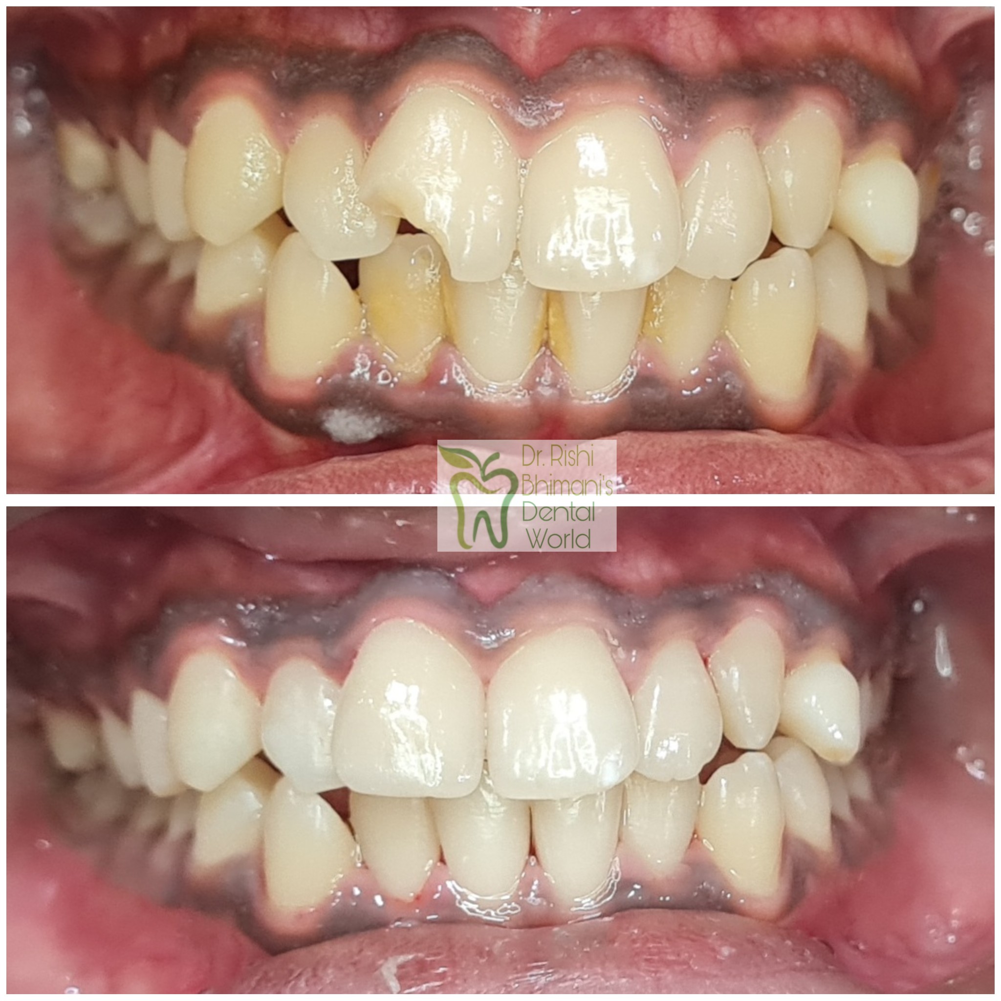 Front Teeth may chip or fracture due to traumat... main image