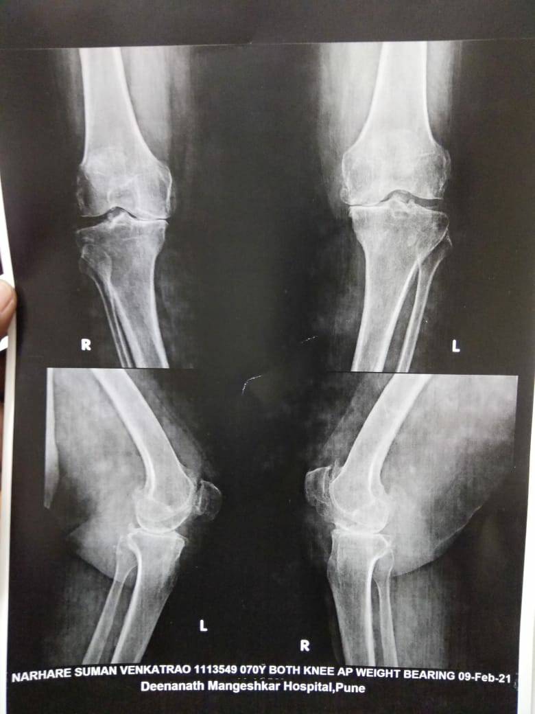 World Arthritis Day.
Joint pain is one of the c... main image