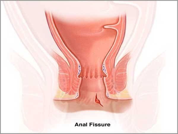 Fissurectomy is one of the options among those ... main image