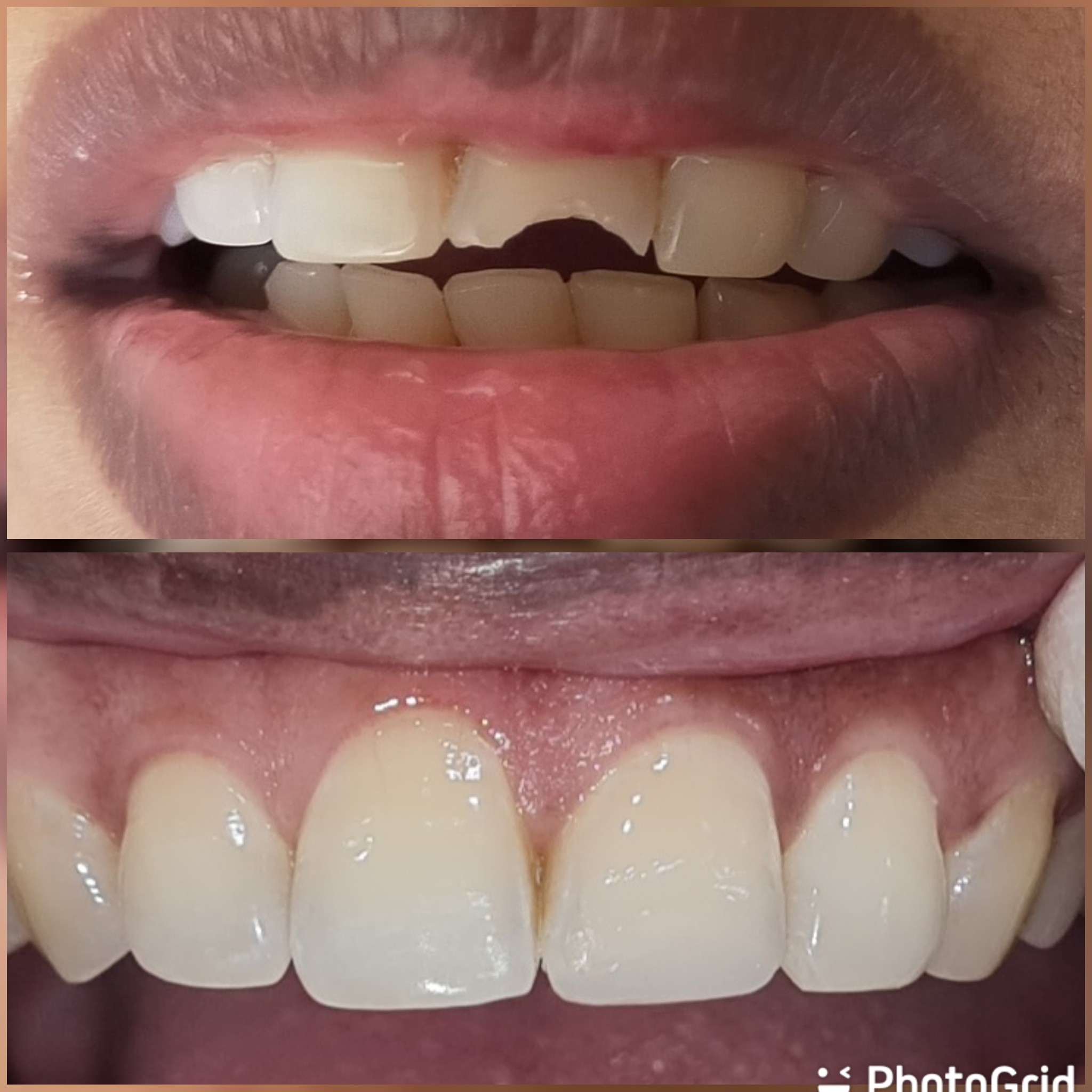 Front Teeth may chip or fracture due to traumat... main image