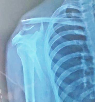 Fracture clavicle lateral end is natorious inju... main image
