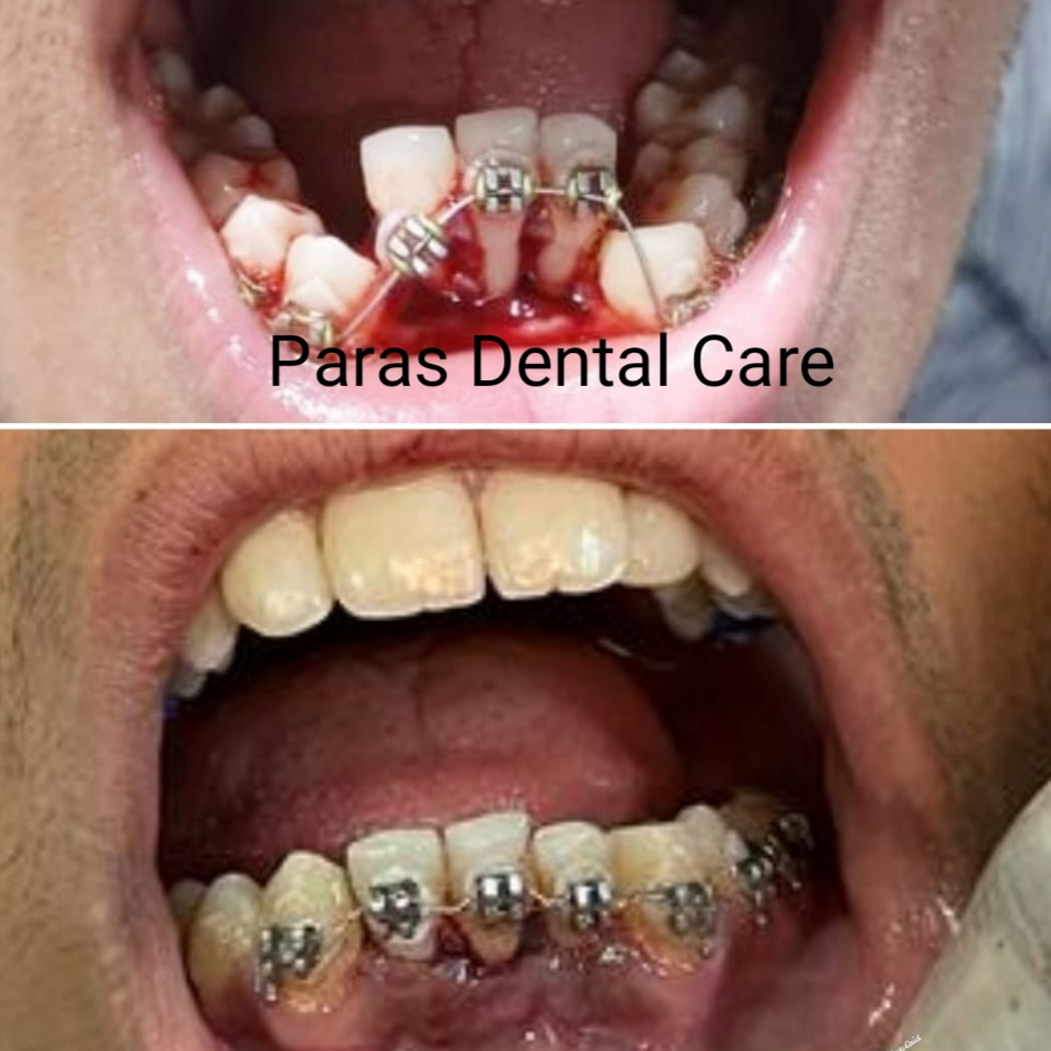 A patient came to us with history of recent tra... main image