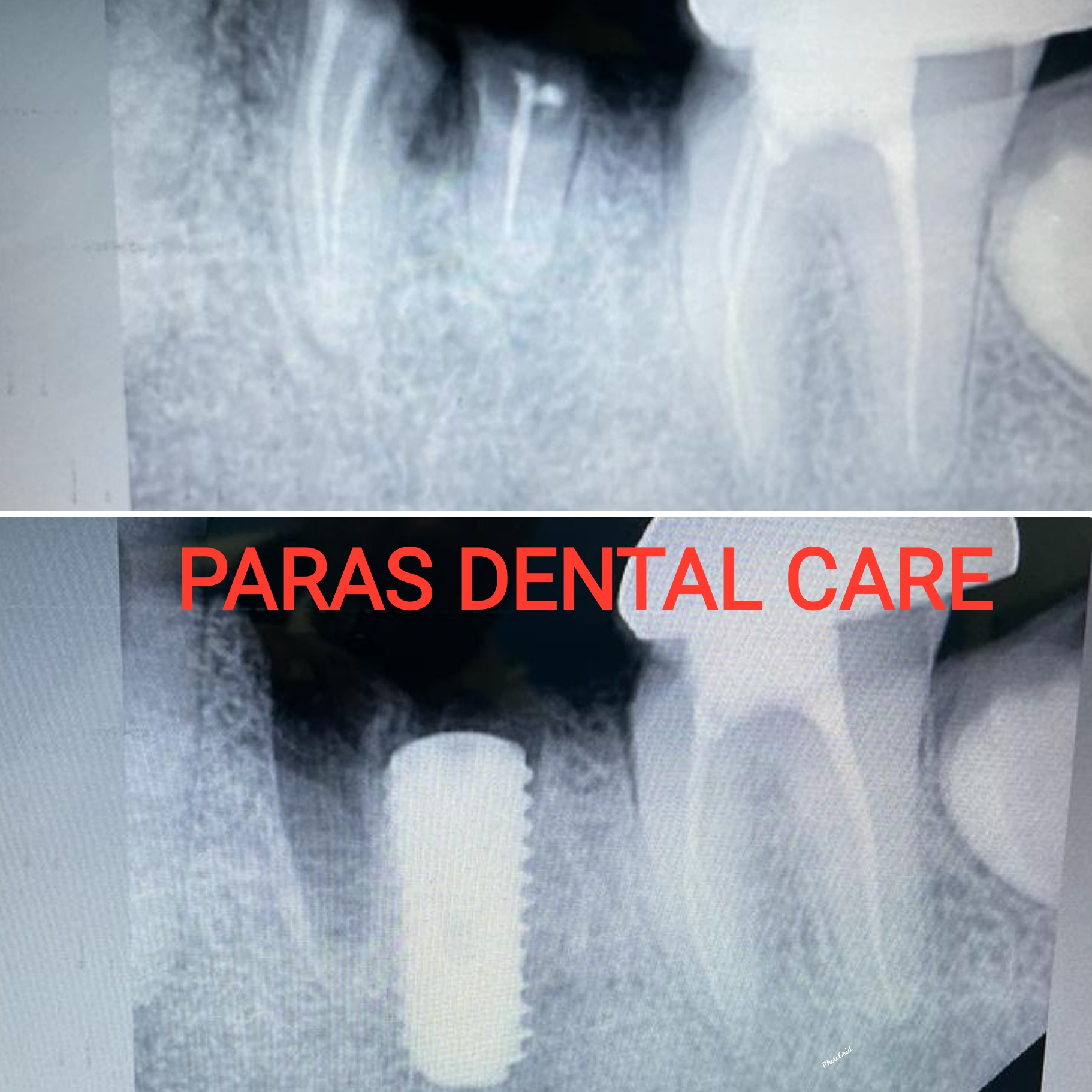 Patient presented with grossly decayed lower mo... main image