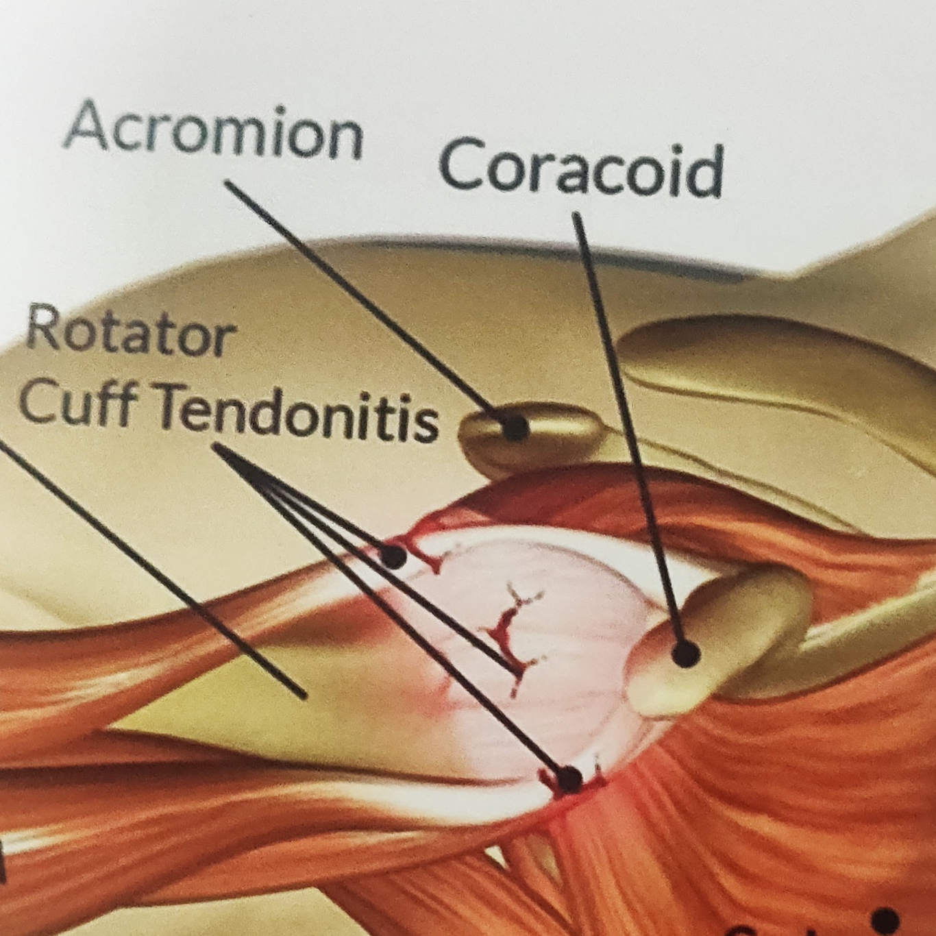 rotator of injury is one of the commonest cause... main image