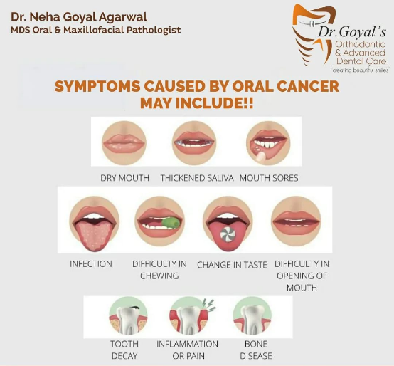 Oral cancer (mouth cancer) is the broad term fo... main image