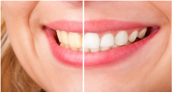 Teeth Whitening
Teeth whitening is one of the m... main image