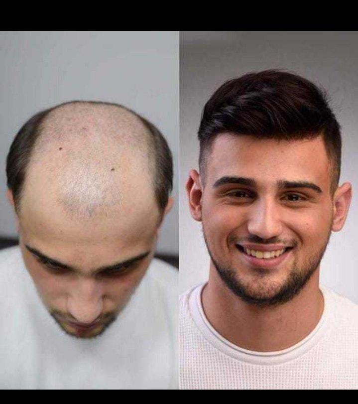 hair-patches-hair-wig-patch-is-a-cap-shaped-p-hair2wear