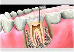 Root Canal Treatment In Navi Mumbai.

Single ap... main image