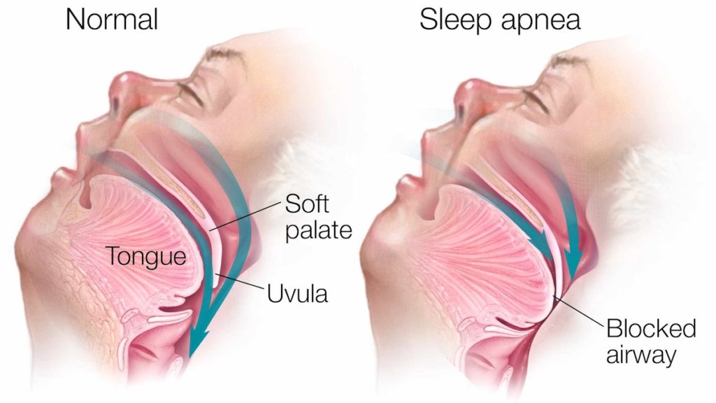 Sleep Apnoea Treatment Najafgarh
Pearl Hospita... main image