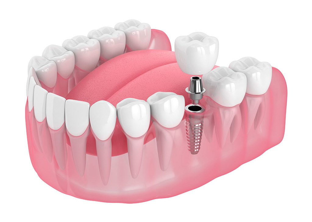 Dental Implant
Dental implants enhance smiles w... main image