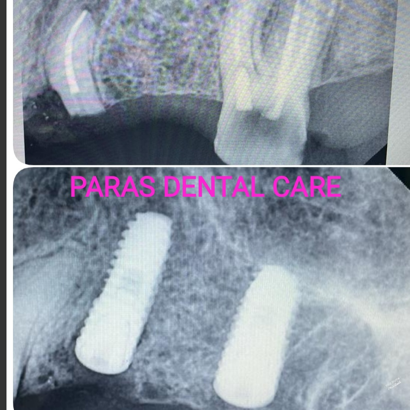 When a tooth is lost due to injury or disease, ... main image