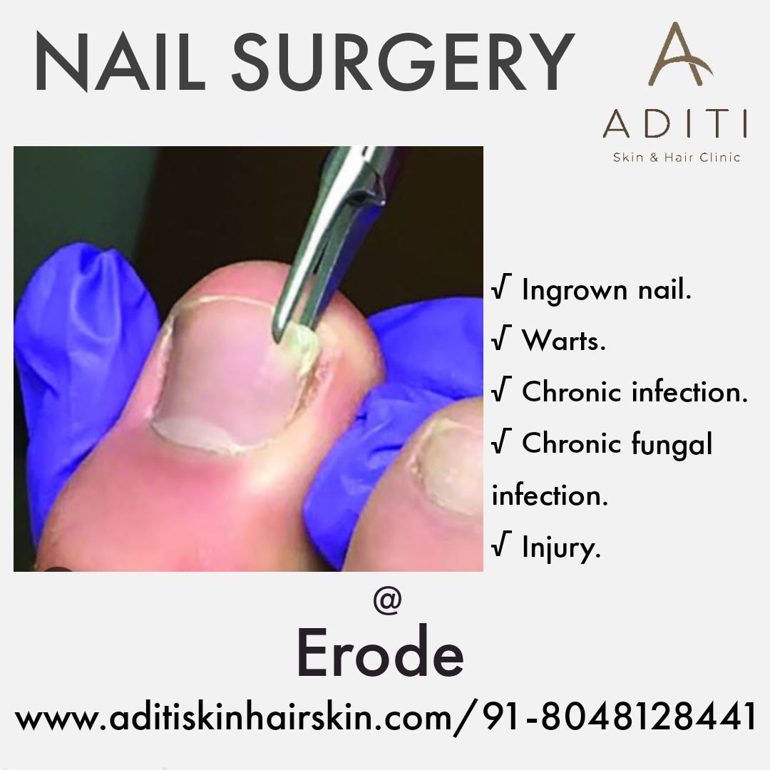 Nail avulsion is a procedure to remove your nail p