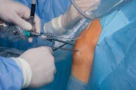 Arthroscopy is a minimally invasive surgical pr... main image