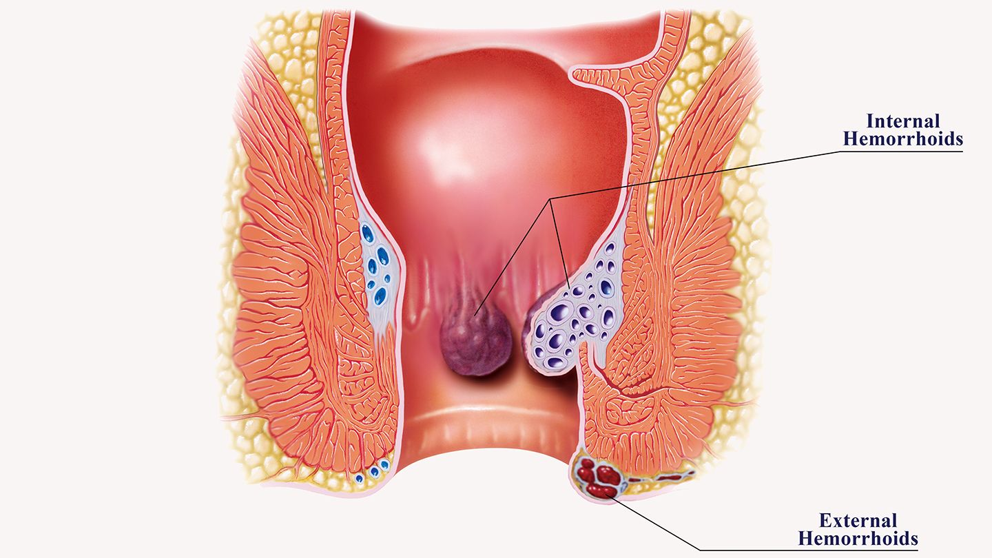 External Piles:-
These are under the skin aroun... main image