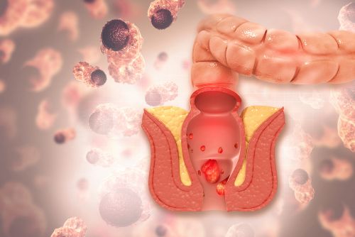 Hemorrhoids can bleed when they become damaged ... main image