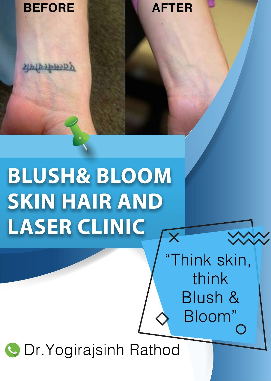 get rid of unwanted tatoo with our world class ... main image