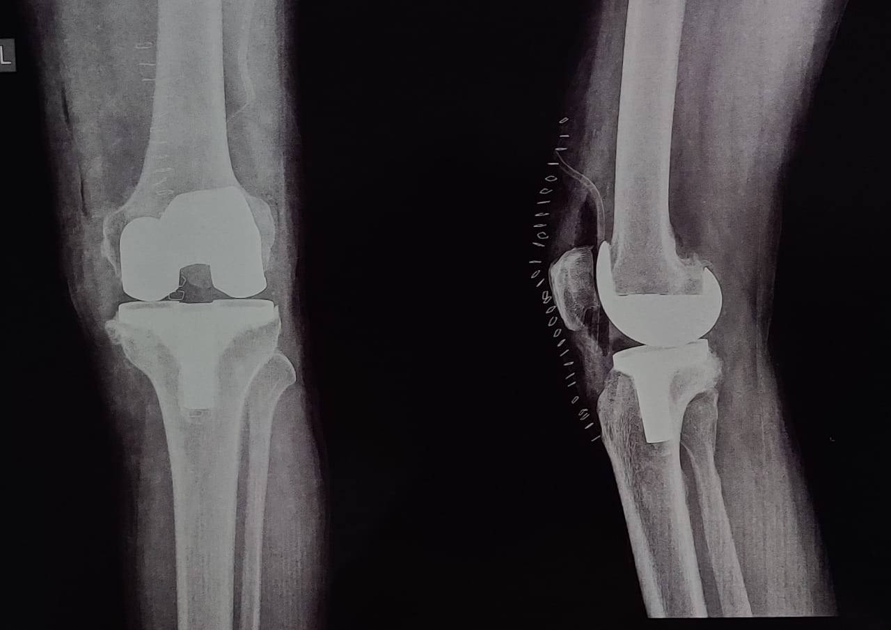 Robotic knee replacement surgery improves accur... main image