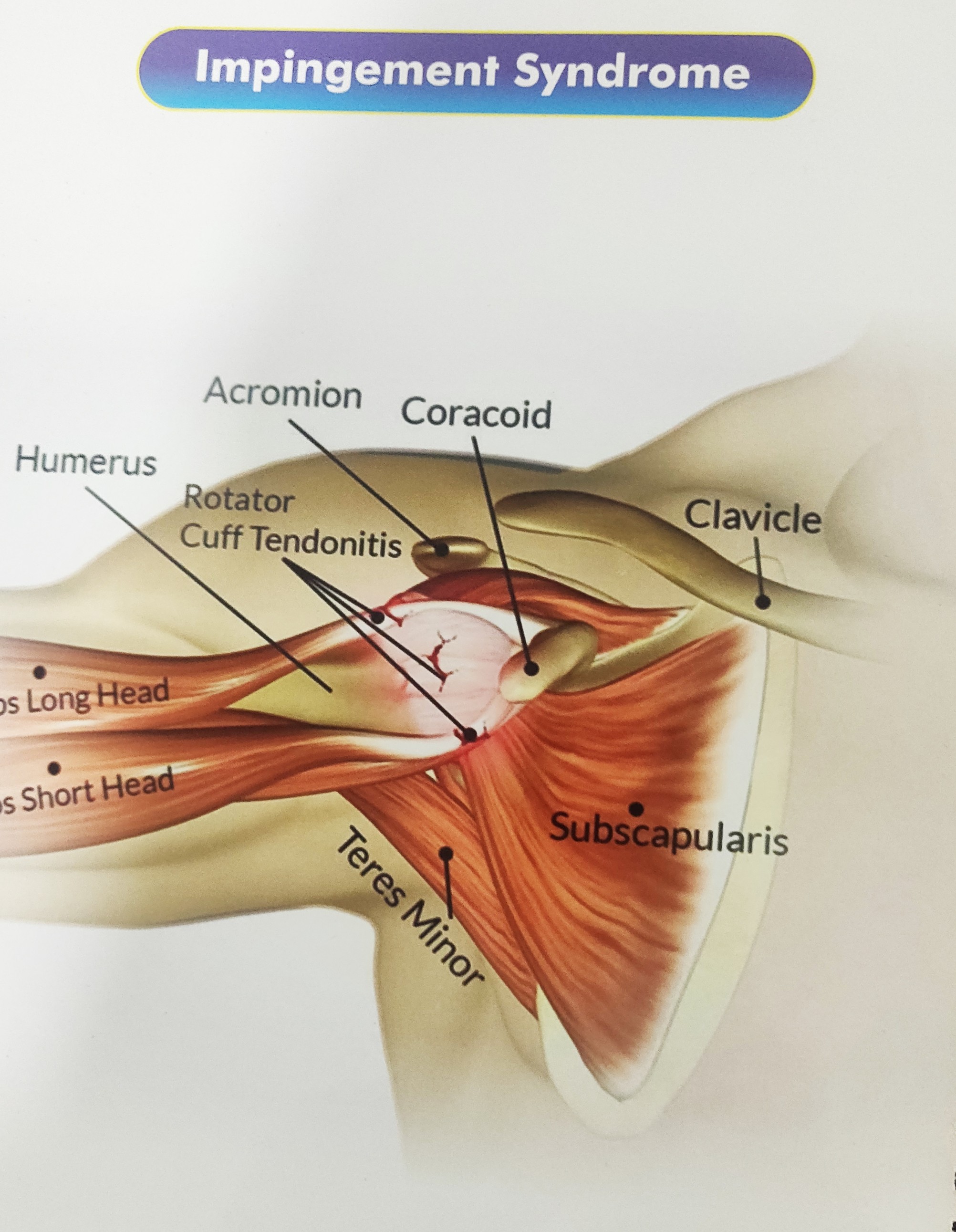 Frozen shoulder? Painful movements?
Don't suffe... main image