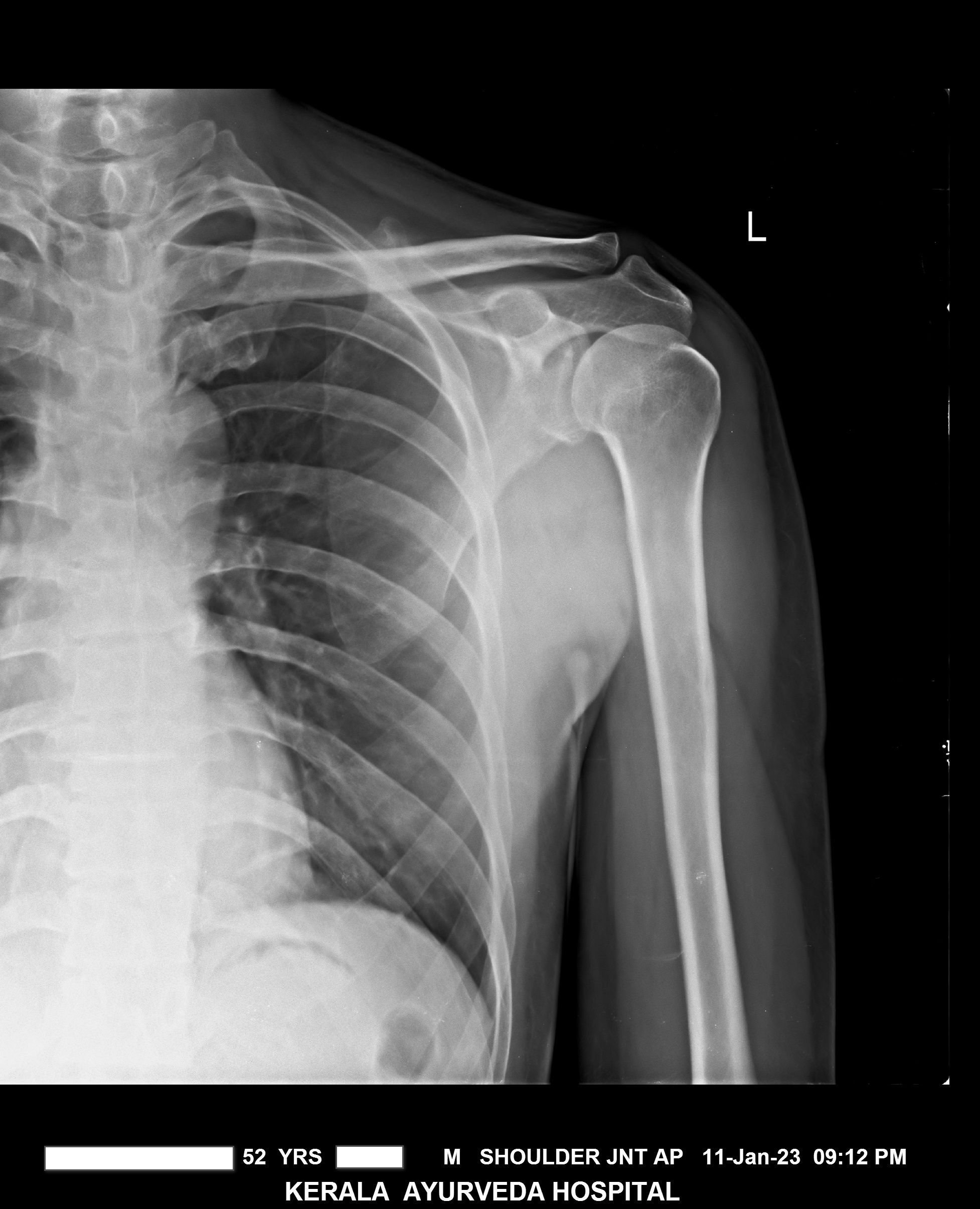 best ayurveda hospital for periarthritis shoulder kerala ayurveda