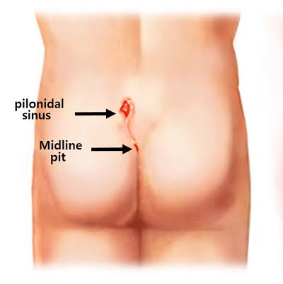 #LASER #PILONIDOPLASTY:-
Laser Surgery for Pilo... main image