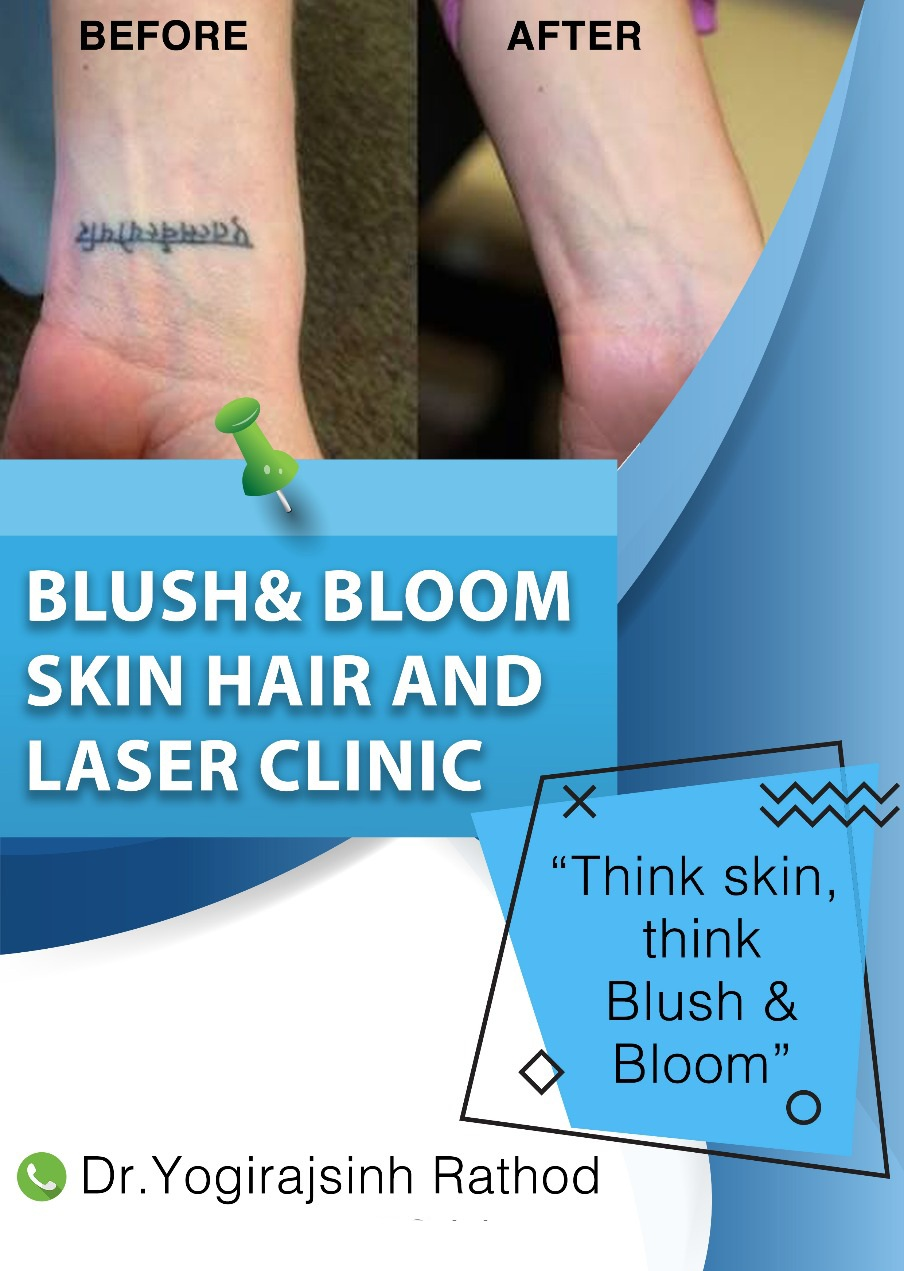 Laser tattoo removal has become a popular solut... main image