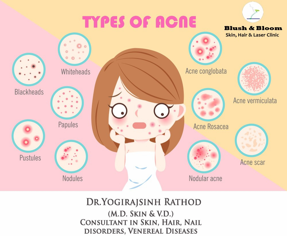 There are several myths about acne that are com... main image
