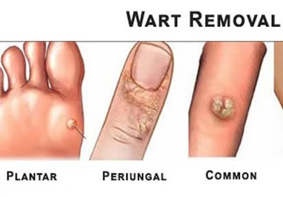 viral warts / skin warts -

Warts are a common ... main image