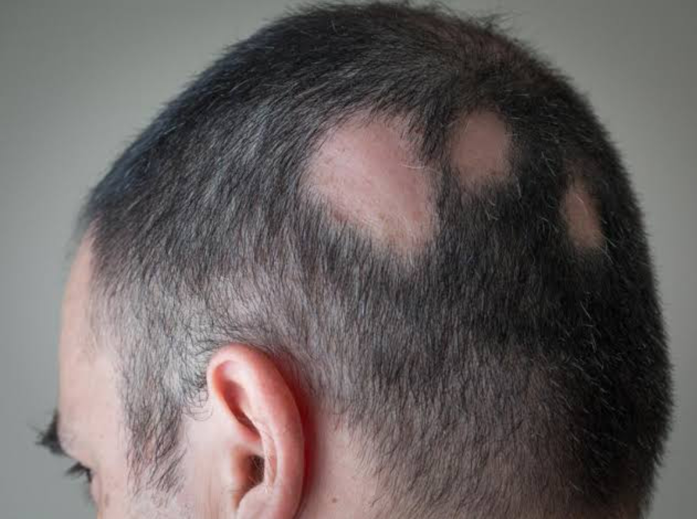 Alopecia areata is a condition that affects mil... main image