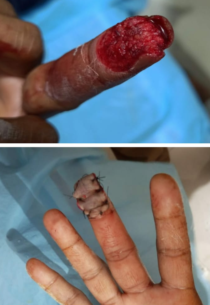 When there is raw area with skin loss due to in... main image