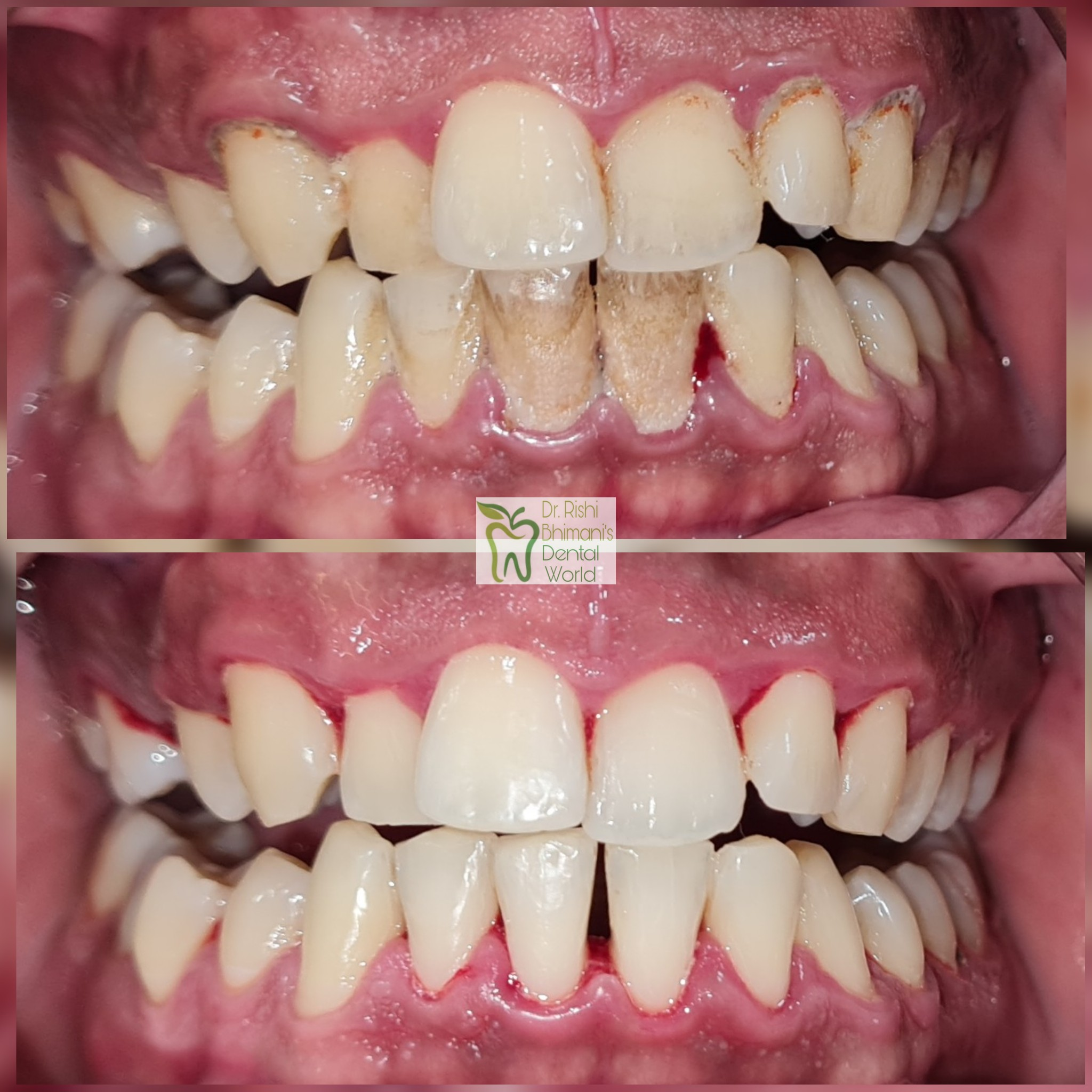 SCALING & POLISHING or TEETH CLEANING is a simp... main image