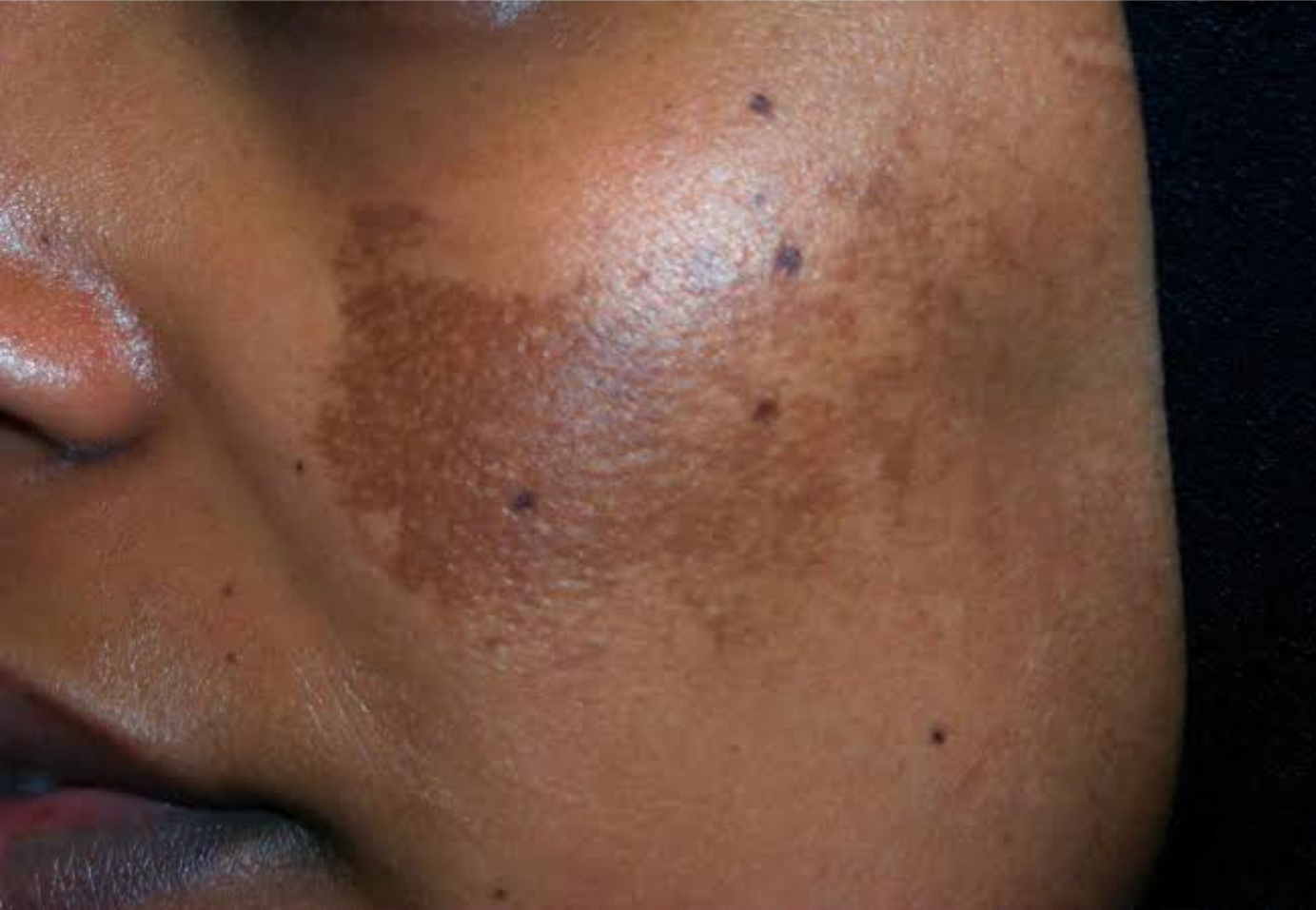 

Melasma: Understanding and Treating the Skin ... main image