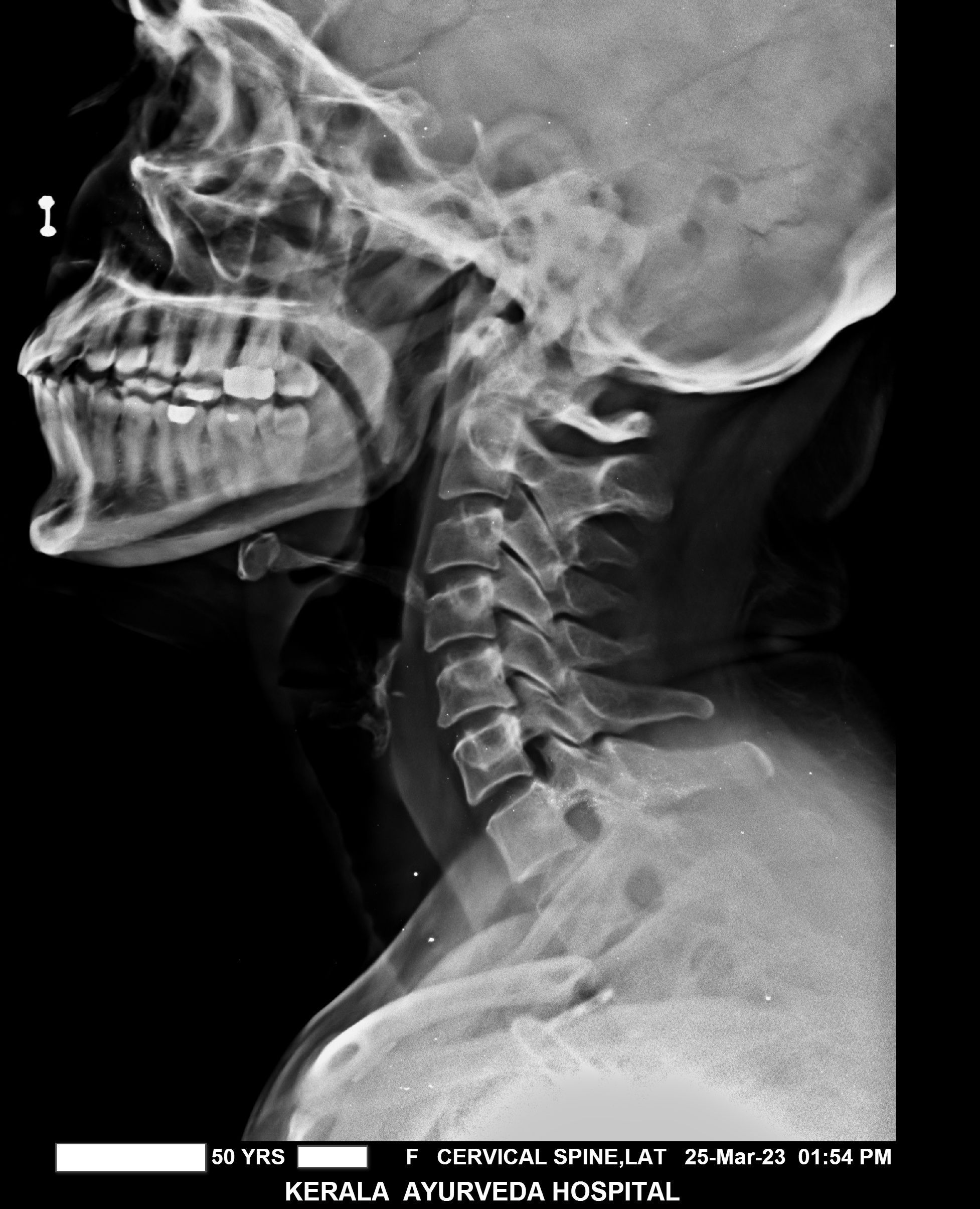 best ayurveda hospital for cervical spondylosis kerala ayurveda hospital is the best ayurveda