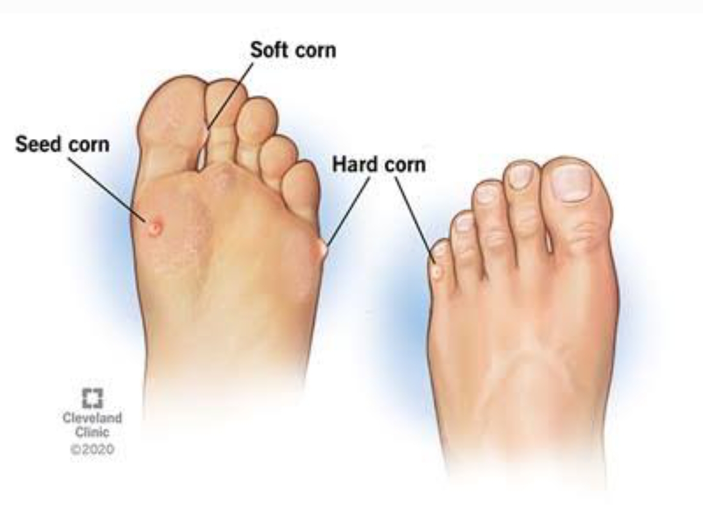 



Plantar corns, also known as foot corns, ar... main image