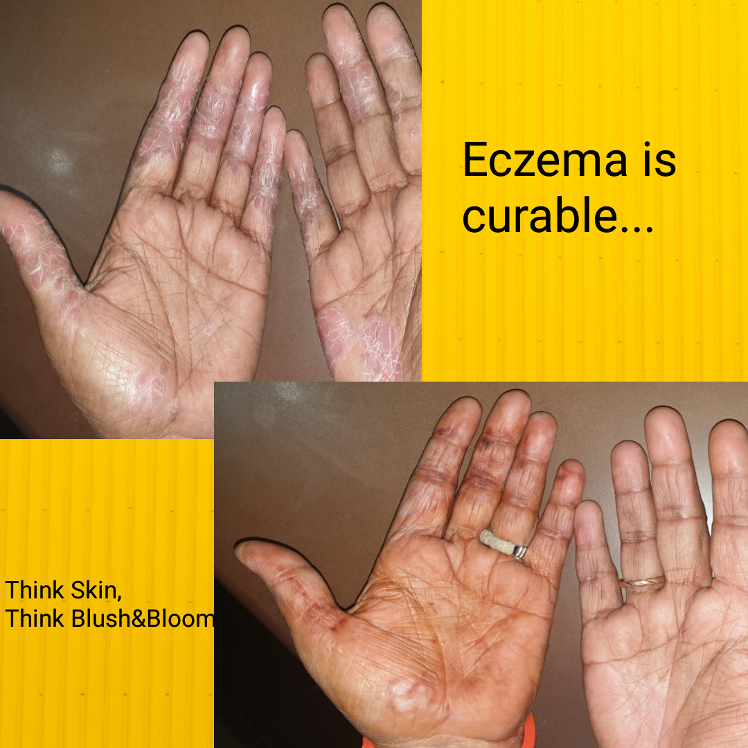 Open sidebar



Eczema: Understanding the Condi... main image