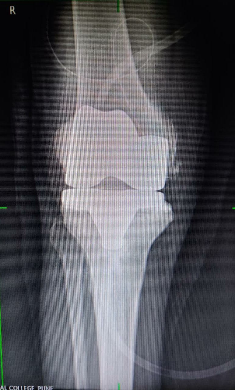Best knee replacement surgery in Pune.
If you a... main image