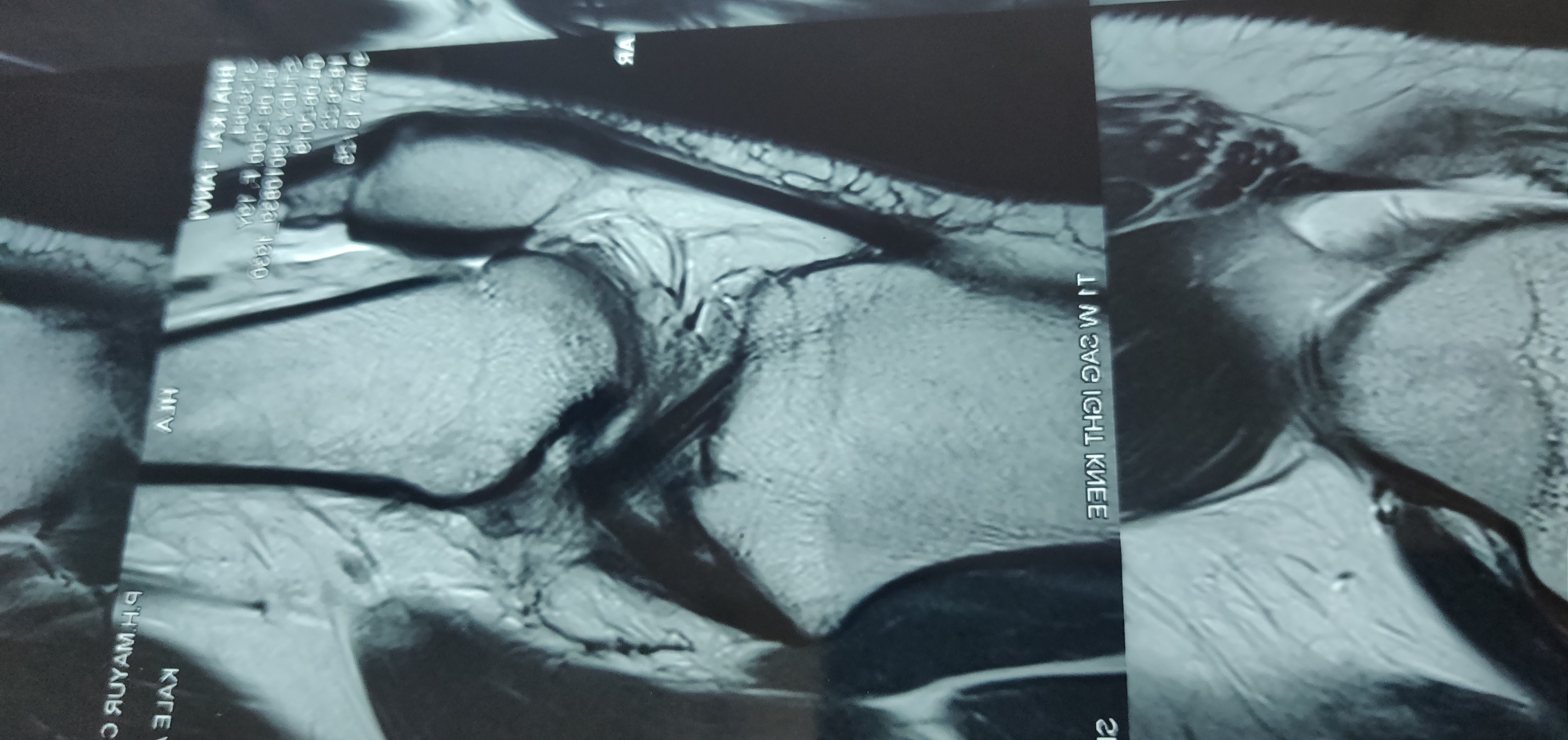 Knee arthroscopic surgery is key hole surgery .... main image