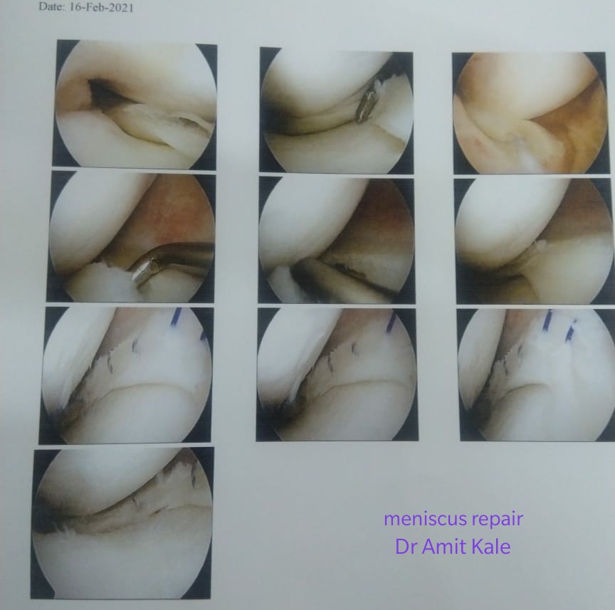 Knee arthroscopic surgery is key hole surgery .... main image