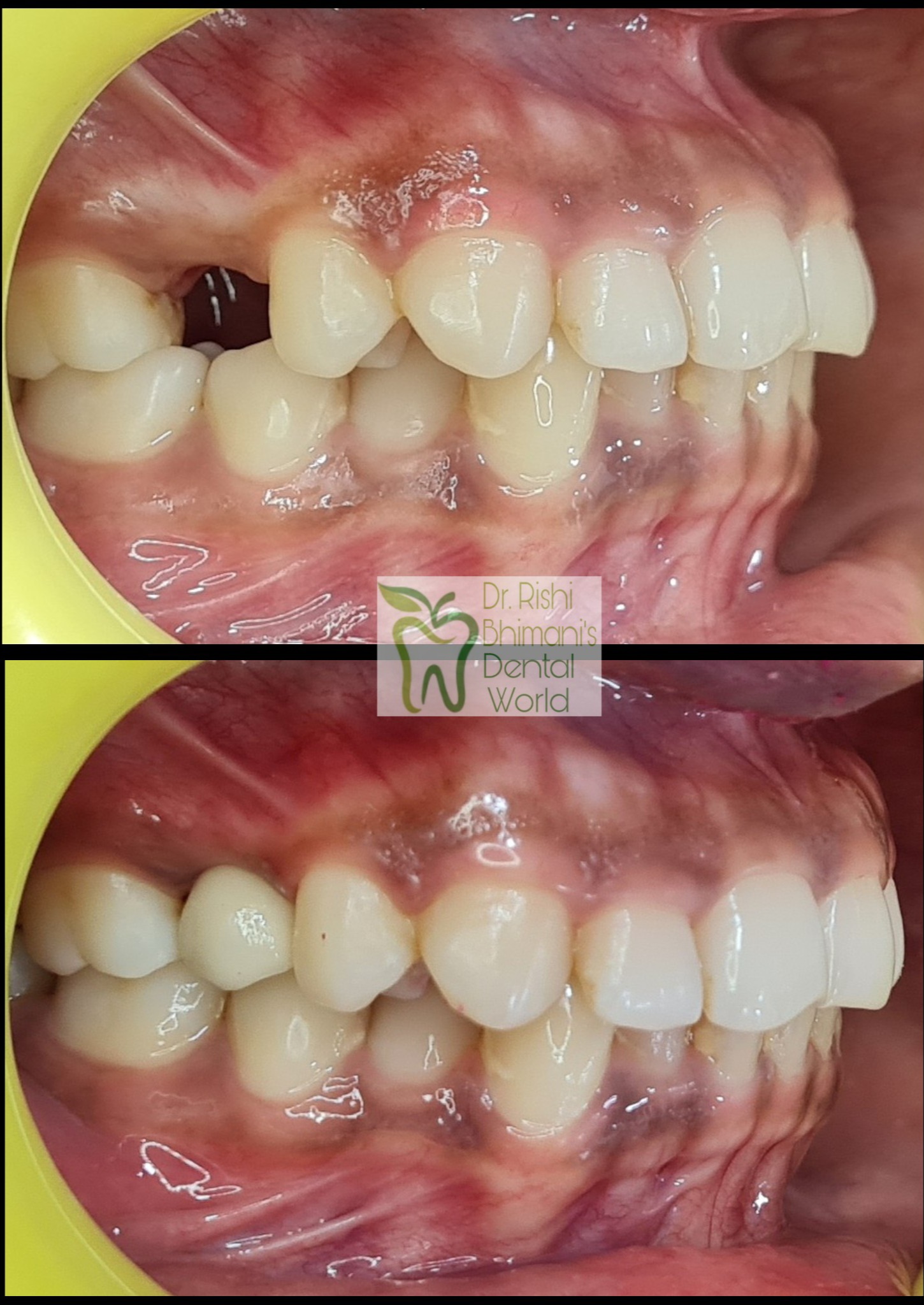 MISSING TEETH can adversely hamper the chewing ... main image