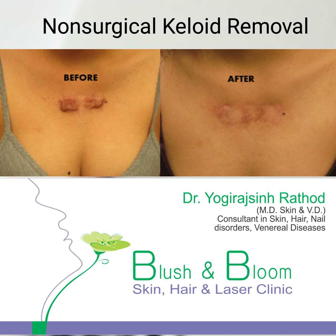 

Keloids are a type of raised scar that can fo... main image