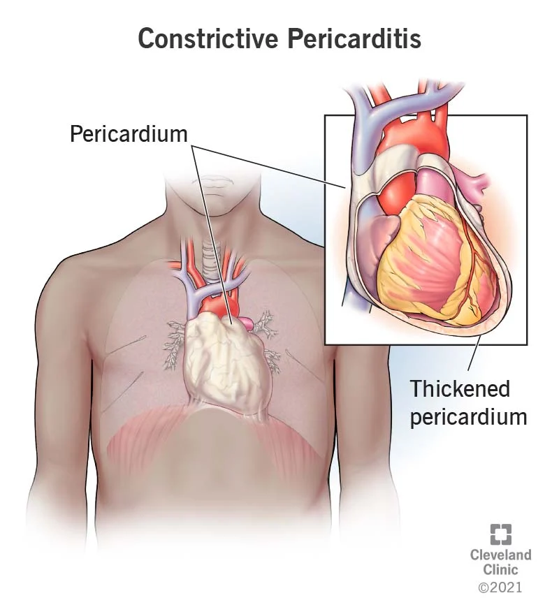 Pericarditis Treatment ( Heart disease ) 
Is li... main image