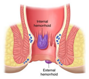 Piles Treatment 
ADR Therapy ( Anorectal  Disea... main image